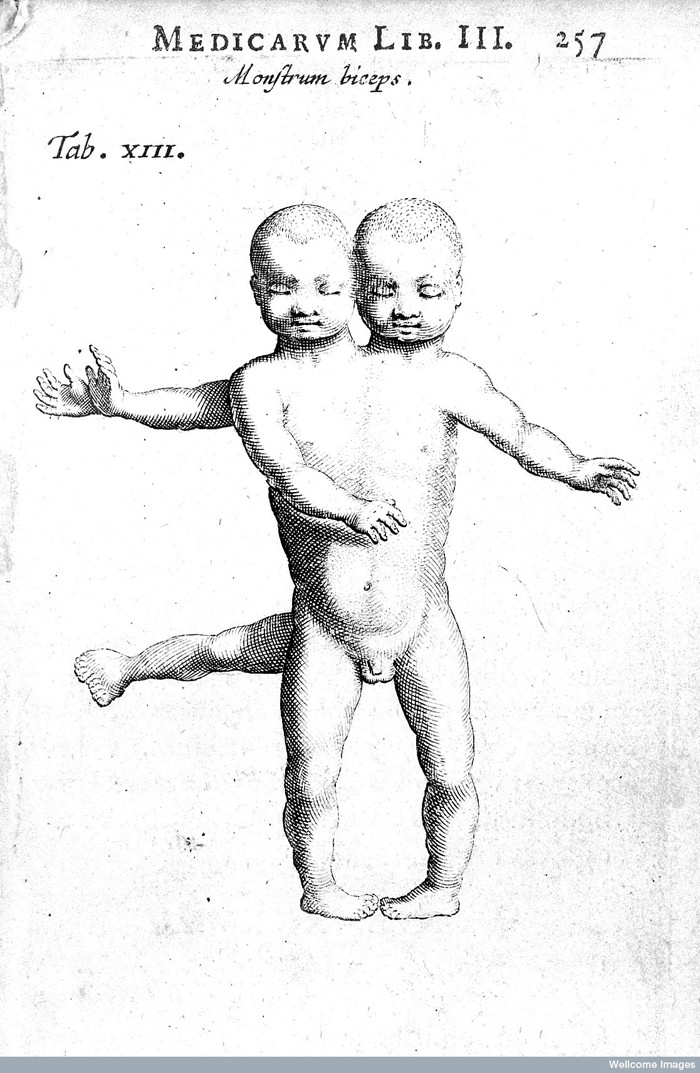 L0016284 Conjoined twins Credit: Wellcome Library, London. Wellcome Images images@wellcome.ac.uk http://wellcomeimages.org Conjoined twins Observationes medicae. Editio nova Nicolaus Tulpius Published: 1652 Copyrighted work available under Creative Commons Attribution only licence CC BY 4.0 http://creativecommons.org/licenses/by/4.0/