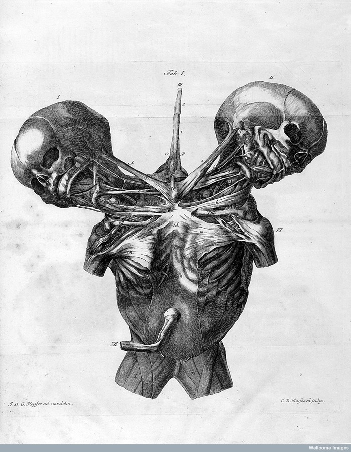 L0023731 J.F. Mekel, De duplicitate monstrosa...1815 Credit: Wellcome Library, London. Wellcome Images images@wellcome.ac.uk http://wellcomeimages.org J.F. Meckel, Conjoined twins. De duplicitate monstrosa commentarius Johann Friedrich II Meckel Published: 1815 Copyrighted work available under Creative Commons Attribution only licence CC BY 4.0 http://creativecommons.org/licenses/by/4.0/