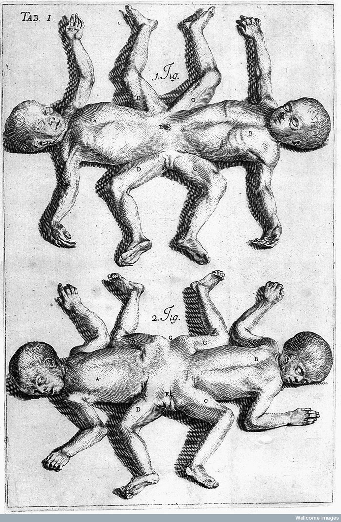 L0023732 Palfyn, Description anatomique des parties... Credit: Wellcome Library, London. Wellcome Images images@wellcome.ac.uk http://wellcomeimages.org Two conjoined twins, both born on 28 April 1703. Engraving 1708 Description anatomique des parties de la femme, qui servent a la generation; avec un Traite des monstres  Jean PalfynFortunio Liceti Published: 1708 Copyrighted work available under Creative Commons Attribution only licence CC BY 4.0 http://creativecommons.org/licenses/by/4.0/
