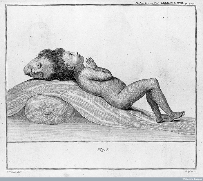 L0023733 E. Home, An account of a child with a double head. Credit: Wellcome Library, London. Wellcome Images images@wellcome.ac.uk http://wellcomeimages.org Child with double head lying on his back. An ccount of a child with a double Head Everard Home Published: 1790 Copyrighted work available under Creative Commons Attribution only licence CC BY 4.0 http://creativecommons.org/licenses/by/4.0/