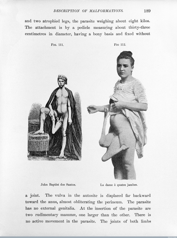 L0027956 B. C. Hirst & G. A. Piersol, Human monstrosities Credit: Wellcome Library, London. Wellcome Images images@wellcome.ac.uk http://wellcomeimages.org John Baptist dos Santos and la dame a quatre jambes. Human monstrosities B.C. Hirst and G.A. Piersol Published: 1893 Copyrighted work available under Creative Commons Attribution only licence CC BY 4.0 http://creativecommons.org/licenses/by/4.0/