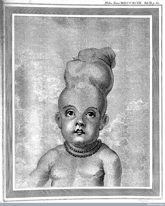 L0029106 E. Home; Account of Child with a double head. Credit: Wellcome Library, London. Wellcome Images images@wellcome.ac.uk http://wellcomeimages.org Child with double head at age twenty months. Account of child with a double head Everard Home Published: 1790 Copyrighted work available under Creative Commons Attribution only licence CC BY 4.0 http://creativecommons.org/licenses/by/4.0/