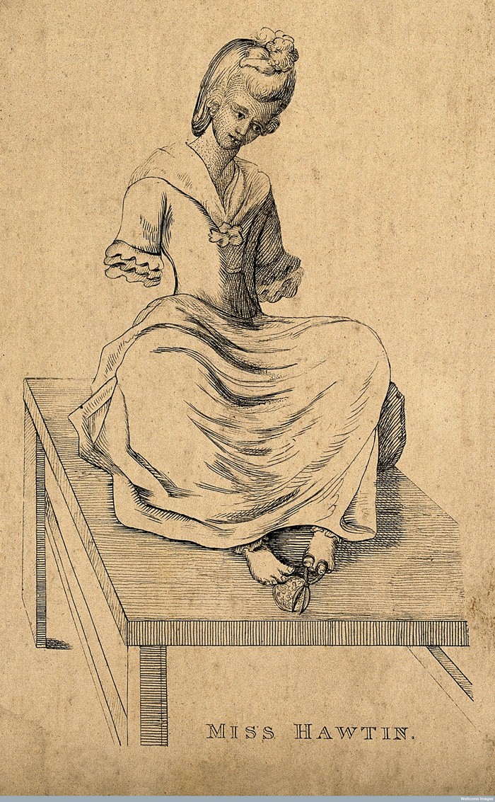 V0007123 Miss Hawtin, born without arms. Etching. Credit: Wellcome Library, London. Wellcome Images images@wellcome.ac.uk http://wellcomeimages.org Miss Hawtin, born without arms. Etching. Published:  -  Copyrighted work available under Creative Commons Attribution only licence CC BY 4.0 http://creativecommons.org/licenses/by/4.0/