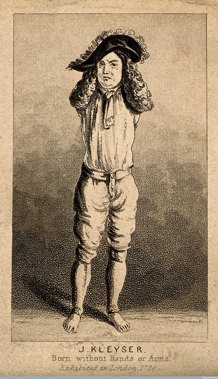 V0007158 Johann Kleyser, a man born without arms. Aquatint. Credit: Wellcome Library, London. Wellcome Images images@wellcome.ac.uk http://wellcomeimages.org Johann Kleyser, a man born without arms. Aquatint. Published:  -  Copyrighted work available under Creative Commons Attribution only licence CC BY 4.0 http://creativecommons.org/licenses/by/4.0/