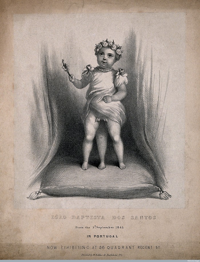 V0007222 Iòao Baptista dos Santos, a diphallic boy with supernumerary Credit: Wellcome Library, London. Wellcome Images images@wellcome.ac.uk http://wellcomeimages.org Iòao Baptista dos Santos, a diphallic boy with supernumerary legs. Lithograph by W. Kohler. after: W KohlerPublished:  -  Copyrighted work available under Creative Commons Attribution only licence CC BY 4.0 http://creativecommons.org/licenses/by/4.0/