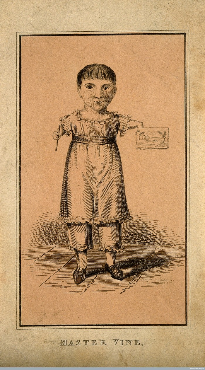 V0007290 Master Vine, a child with deformed arms. Etching. Credit: Wellcome Library, London. Wellcome Images images@wellcome.ac.uk http://wellcomeimages.org Master Vine, a child with deformed arms. Etching. Published:  -  Copyrighted work available under Creative Commons Attribution only licence CC BY 4.0 http://creativecommons.org/licenses/by/4.0/