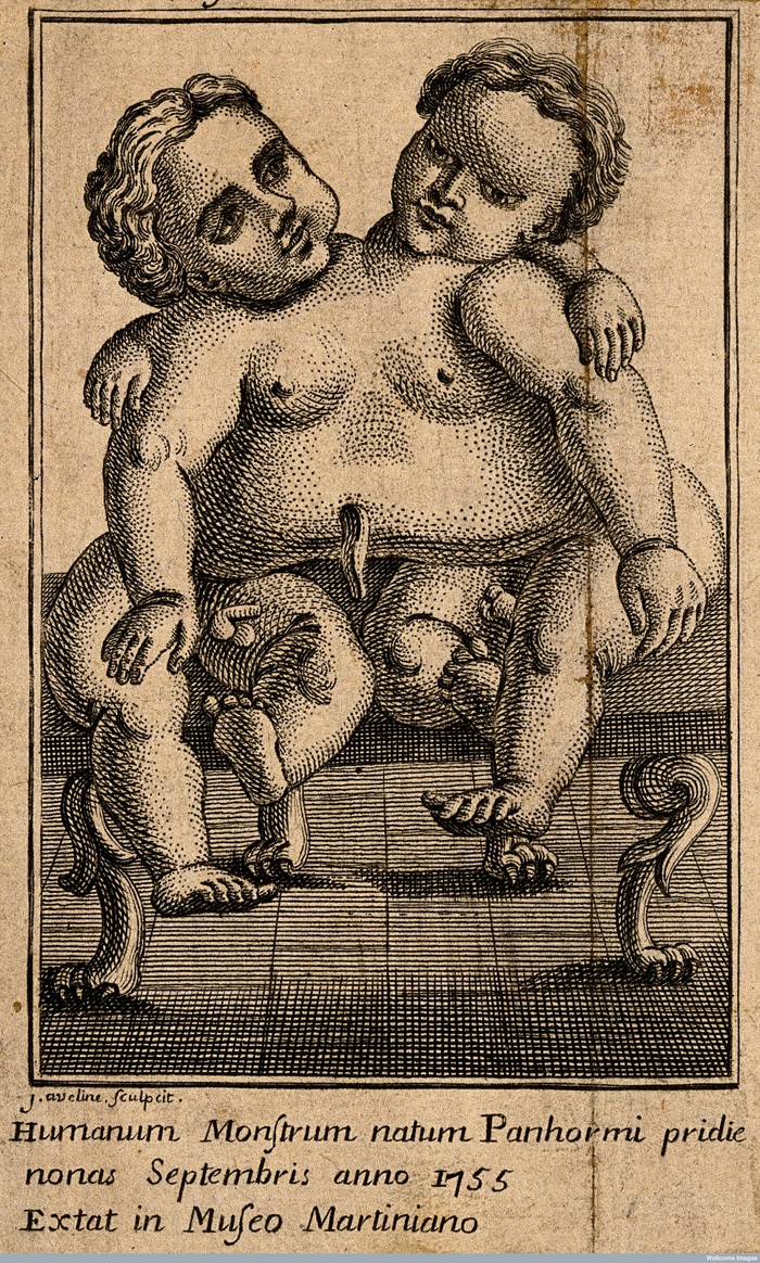 V0007384 Conjoint twins born at Palermo in 1755. Engraving by J. Avel Credit: Wellcome Library, London. Wellcome Images images@wellcome.ac.uk http://wellcomeimages.org Conjoint twins born at Palermo in 1755. Engraving by J. Aveline. after: Jean Alexandre AvelinePublished:  -  Copyrighted work available under Creative Commons Attribution only licence CC BY 4.0 http://creativecommons.org/licenses/by/4.0/