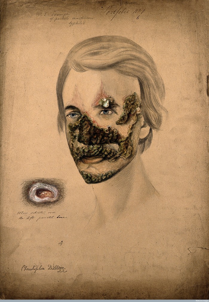 V0009875 Syphilis; severe lesions on face, 1855 Credit: Wellcome Library, London. Wellcome Images images@wellcome.ac.uk http://wellcomeimages.org Pencil, white chalk and watercolour drawing illustrating severe pustule crustaceous lesions on the head of a man suffering from syphilis. The drawing at left shows a detail of the ulcerated lesion above his left eye. Watercolour 1855 By: Christopher D'AltonPublished:  -  Copyrighted work available under Creative Commons Attribution only licence CC BY 4.0 http://creativecommons.org/licenses/by/4.0/