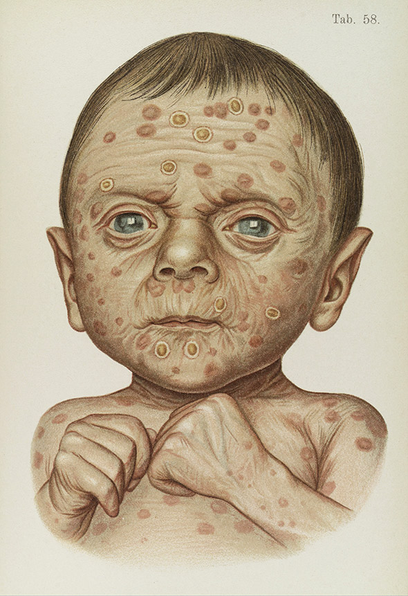 Head, shoulders, and hands of a baby suffering from hereditary syphilis. Lithograph by Franz Mracek, published in Atlas of Syphilis and the Venereal Diseases, 1898.