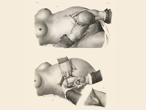 medicalillustration_crucialinterventions-caesarean-section-birth.jpg%0A