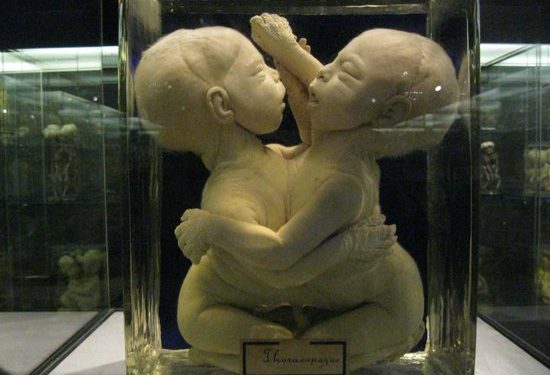 deformed babies in jars    museum vrolik