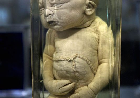 deformed babies in jars u2026 museum vrolik