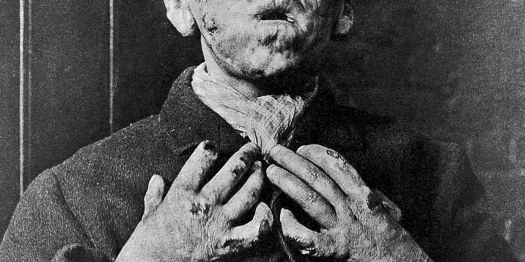 Gross Stuff from the Bible… Images of Leprosy 