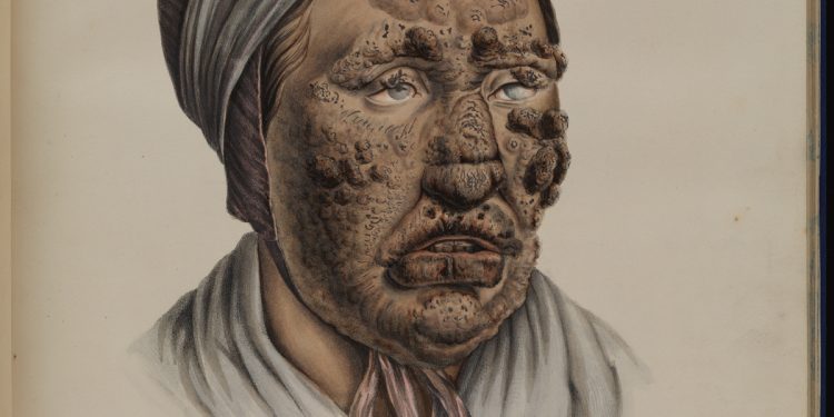 gross stuff from the bible u2026 images of leprosy